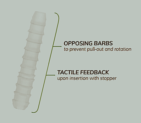 OSSIOfiber® Hammertoe Fixation Implant (Prod 2212114)